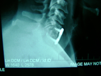 Artificial Cervical Disc