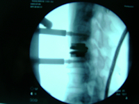 Artificial Cervical Disc