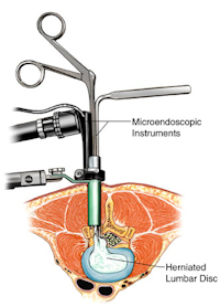 What Is A Herniated Disc?, Advanced Spine Center